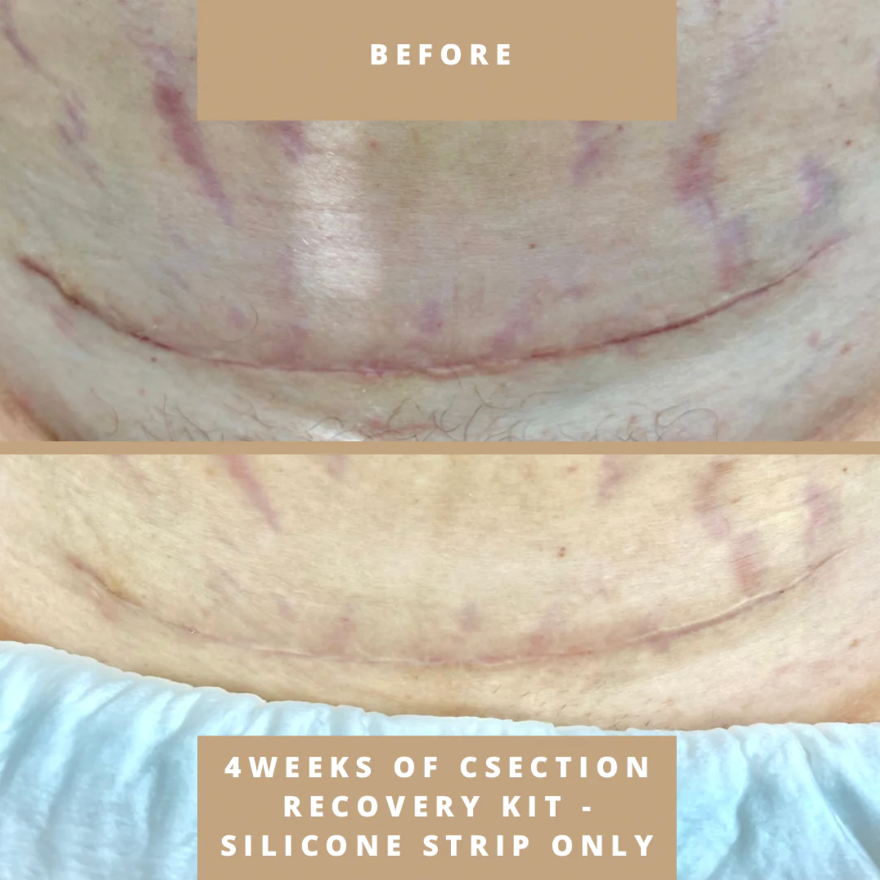 C-Section Scar Recovery Kit with Silicone Patches
