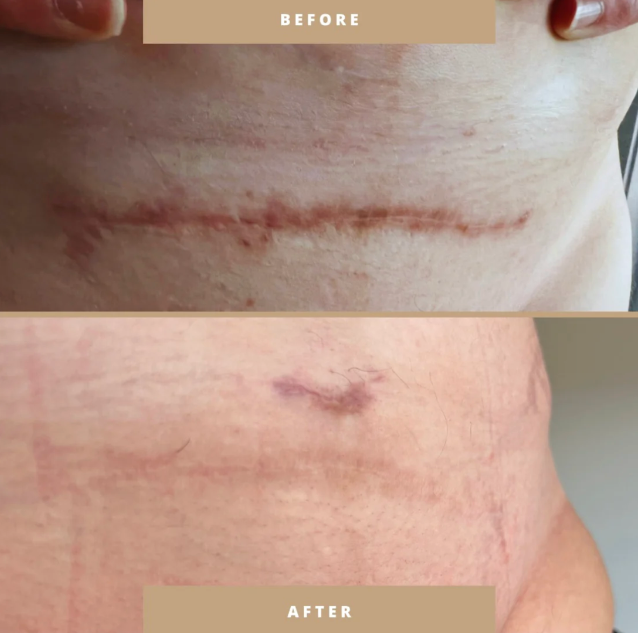 C-Section Scar Recovery Kit with Silicone Patches